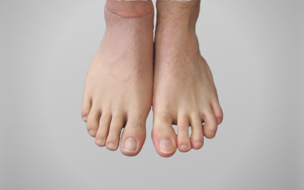 Partial foot amputation – Atlantic Prosthetic Orthotic Services Ltd